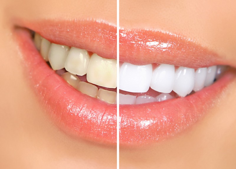 How Long Does It Take for Yellow Teeth to Turn White With Toothpaste? 