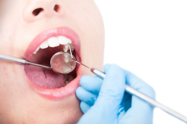 Signs Of Failing Dental Fillings And What To Do About Them